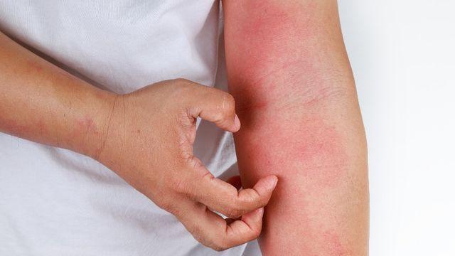 연고 내성 걱정되는 아토피, 단순진정 말고 근본치료로 접근하는 K-연고