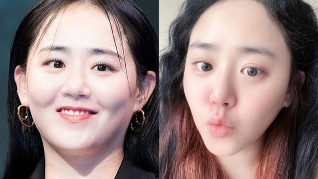 ‘국민 여동생’ 문근영, ‘급성구획증후군 극복→다이어트 성공’ 근황 [RE:스타]