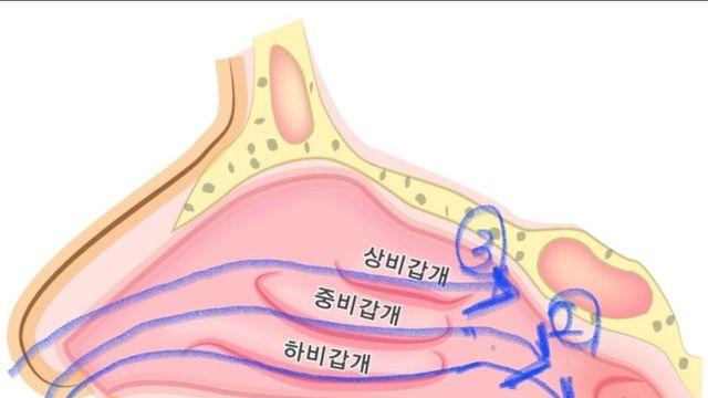 비염수술을 해도 답답한 이유