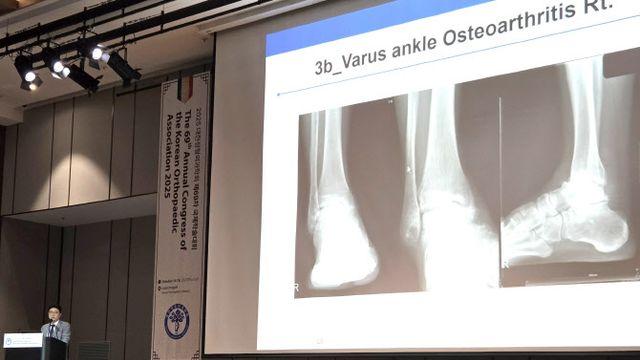 서울부민병원,  하버드 의대와 발목 관절염 교정수술 연구결과 발표