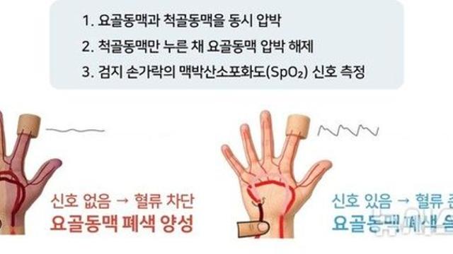 영유아 60%, 수술 후 '요골동맥 폐색'…