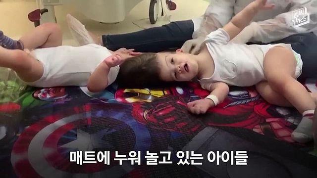 33시간 수술 끝에 얼굴 본 샴쌍둥이