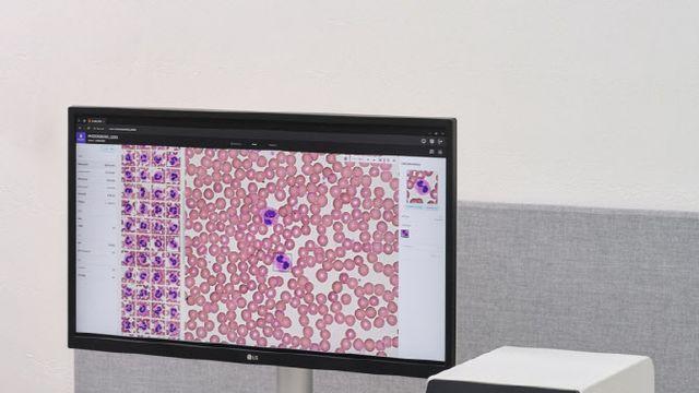노을, 아산병원과 차세대 AI 기반 혈액분석 솔루션 신제품 성능 결과 공개
