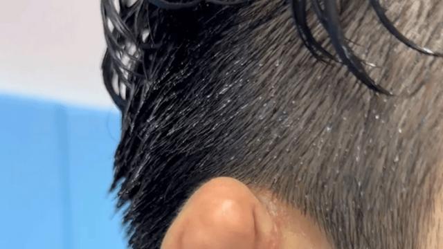 만두귀 의외의 고충