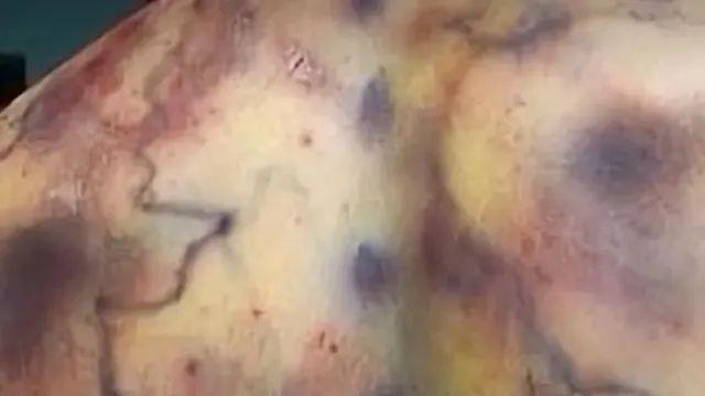 번개 맞은후 피부 변화,,