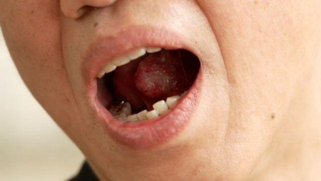 EBS 명의, '염증일까? 암일까? 입속 암의 위험 신호!' 편