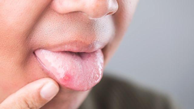 입안 상처 3주 이상 안 낫는다면 '구강암' 신호일 수도