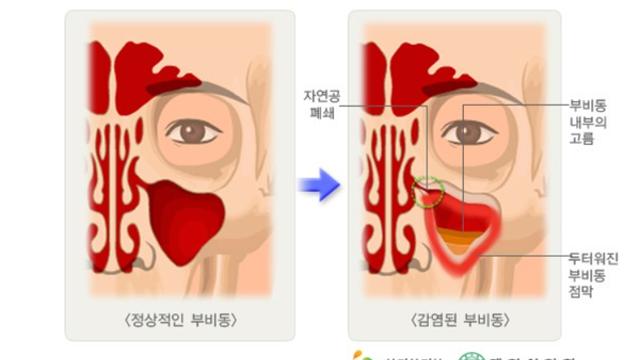 고 백성문 변호사가 투병했던 부비동암은 어떤 암?