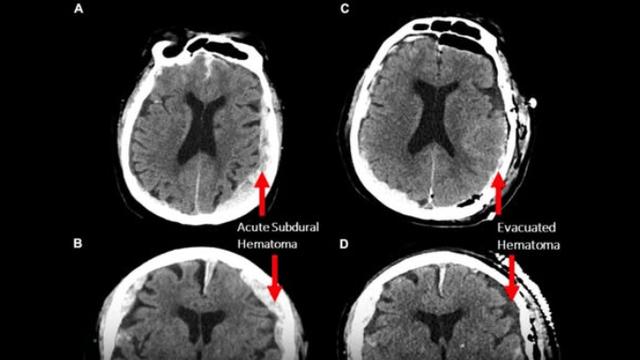 주마등 및 임사체험의 신경학적 근거 발견 