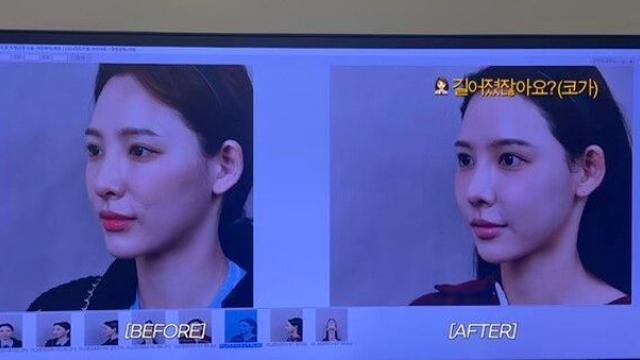 '환승연애2' 이나연, 코 재수술 결정…성형 전후 공개
