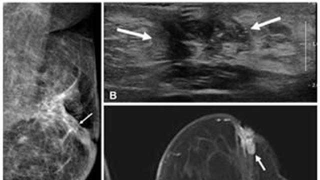 수술 전 MRI, 50세 이하 유방암 환자 재발 예방에 효과적