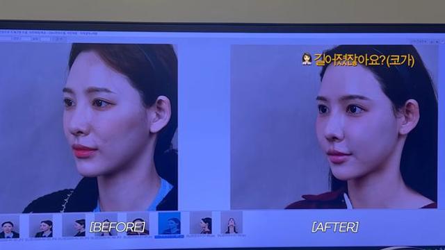 이나연, 코 재수술 결정…비포 사진 보니 