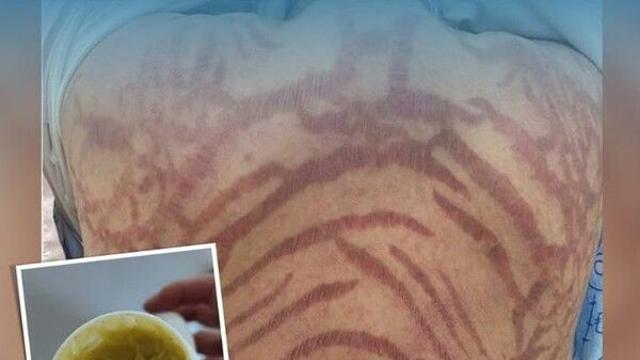 사람 몸에 '뱀 무늬?'…'순수 중의학 연고' 알고보니