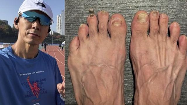션, '세계 7대 마라톤' 완주 후 상처투성이 발 공개 