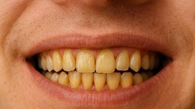 '하얀 이 갖고파'…치과의사가 꼽은 피해야 할 음식 5가지