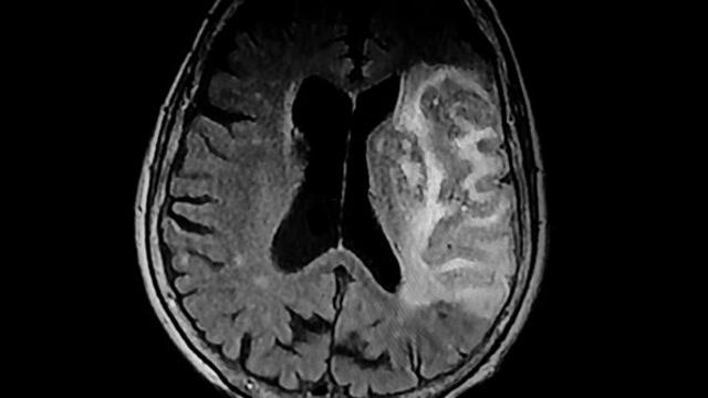 “갑자기 머리가 깨질 듯 아프다면?” 생사를 가르는 뇌출혈의 경고 신호