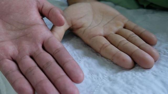 젊은 여성에게 특히 많은 ‘빈혈’, 단순 피로로 넘기면 위험하다