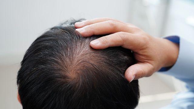 환절기 탈모, 머리카락이 보내는 경고