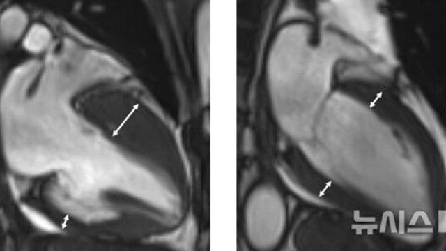 겉으론 멀쩡했는데…30대 급사 부르는 '이 질환' 주의보