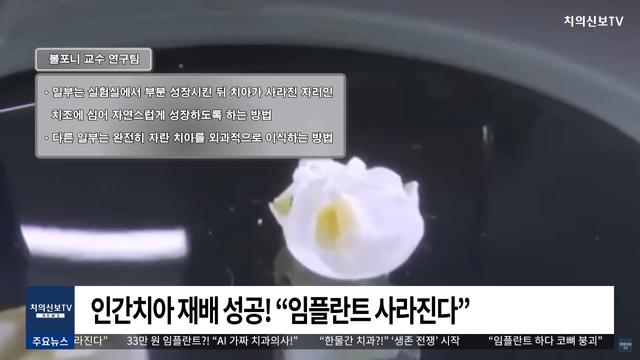 인간치아 재배 성공! 임플란트 사라진다 