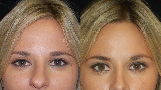 정말 자연스러운 서양의 코 성형수술