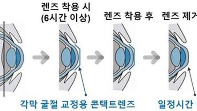 각막굴절 교정용 렌즈 개발 '이렇게'…가이드라인 발간
