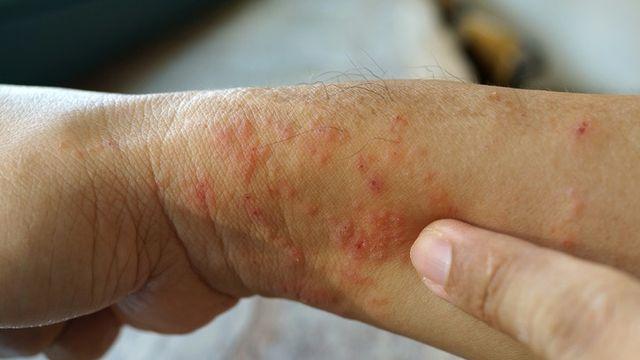 추워지면 왜 건선이 악화될까…겨울철 완화 방법은?