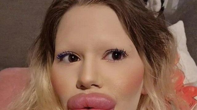 입술 필러에 3800만원 쓴 여성…진료 거부에도 