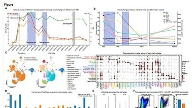 희귀 유전질환 ‘윌슨병’ 혈장교환술 치료 사례 첫 보고