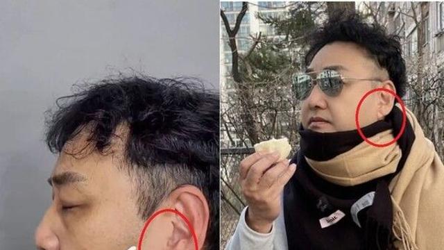 김수용 귓볼 '이것' 전조증상 포착?