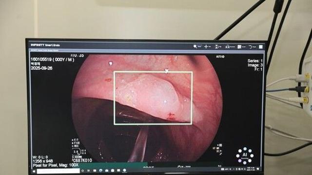 대장내시경 검사에 AI활용했더니…