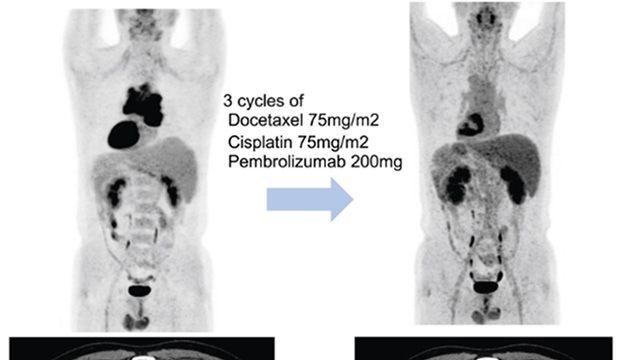 치료 옵션 제한적인 흉선암, 면역항암제 효과 ‘가능성’ 확인