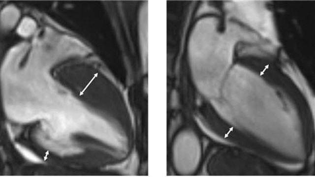 [아는 것이 힘]돌연사 키우는 ‘조용한 병’ 비후성 심근병증 주의