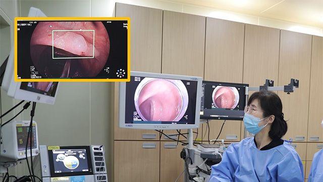 대장내시경, AI 보조로 선종·용종 검출률 높였다
