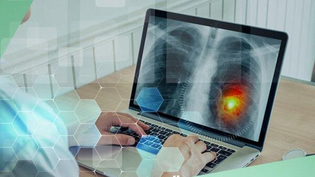 '폐암' 환자 대부분 '4기'에 발견…'의료 AI' 주목 받는다