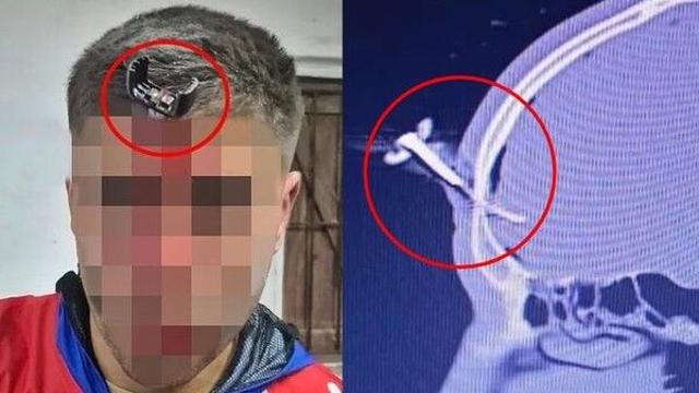 딸 축구 경기 중 부모 싸움 번져…이마에 열쇠 박혀 병원행