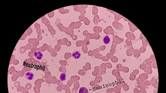 혈액검사 호중구 수치 해석하는 법...이럴 땐 즉시 응급실 가야