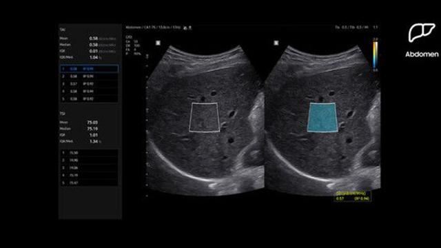 의사 숙련도따라 좌우되는 '간질환'..AI가 94% 찾아낸다[빠정예진]
