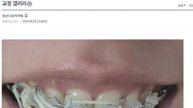 치아교정 고무줄을 단 사람