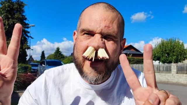 코에 이 것 81개 쑤셔넣기 성공…기네스 기록 등재