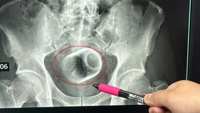 항문 속 컵 3일간 참은 남성…부끄러워 숨기다 장 괴사