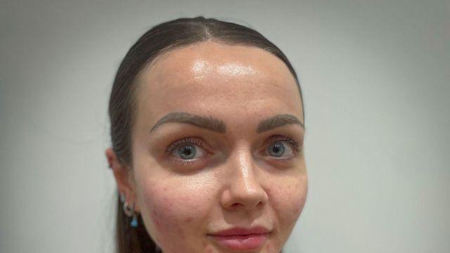 필러 대신 요즘 뜨는 '물고기 정자' 얼굴 주사, 왜 맞을까?