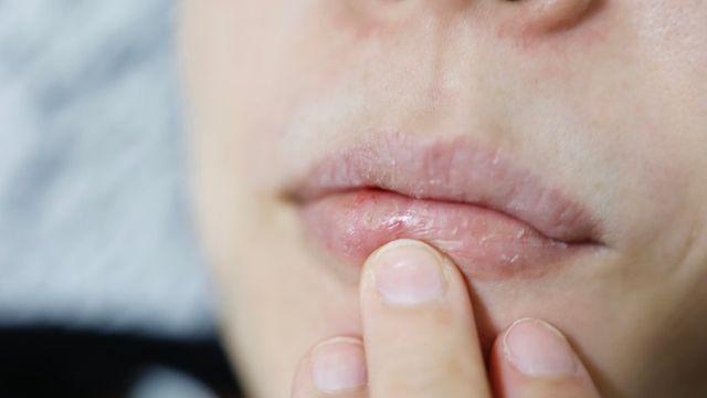 따뜻한 히터 바람에 겨울철 피부 장벽 먼저 무너진다