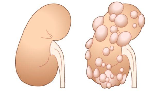 최수정 순천향대 신장내과, 다낭신…가족력 있다면 정기검진 핵심