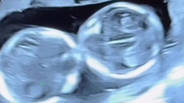 '쌍둥이 임신' 초아, 산부인과 초음파 검사에 90분이나 걸린 이유