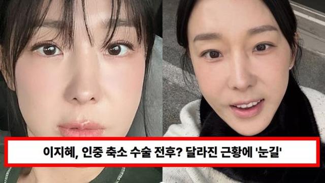 이지혜, 인중 축소 수술 전후? 달라진 얼굴 근황에 '눈길'...