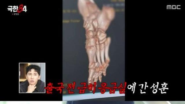 '극한84' 비상! 추성훈, 다리 골절로 1회 만에 '갑작스러운 하차'