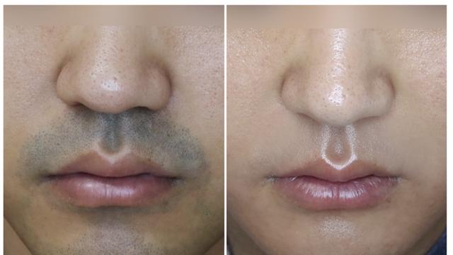 남자들이 절대 후회 안하는 시술 원탑