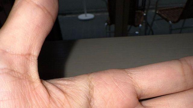 X같이 생긴 사랑니