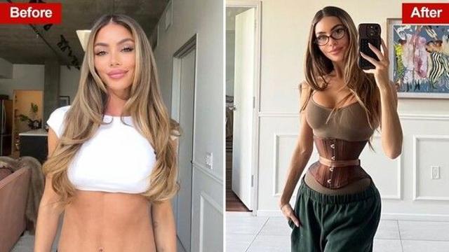 모래시계 몸매 위해 갈비뼈 제거?…美 '개미허리 수술' 논란